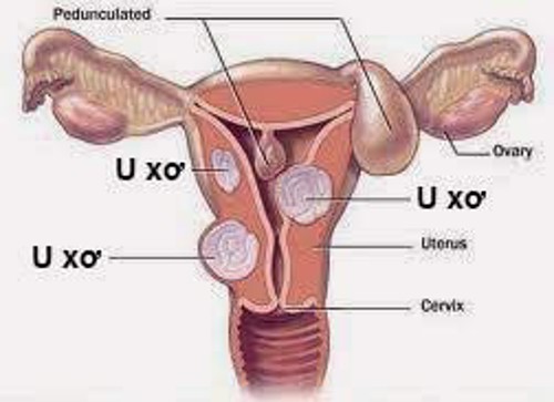 Chuyên gia giải đáp: Nguyên nhân gây u xơ tử cung là gì? 