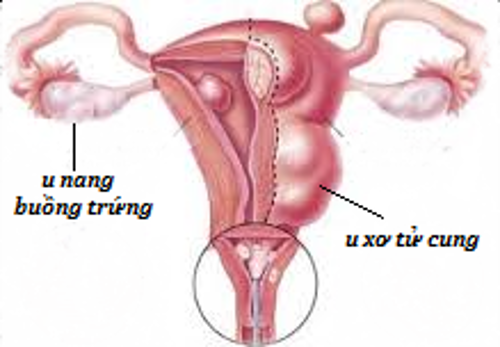 U xơ tử cung, u nang buồng trứng có trở thành ung thư không?