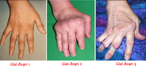 Phân loại các cấp độ trong điều trị viêm khớp dạng thấp như thế nào?