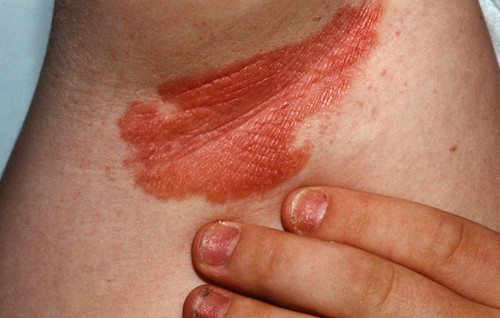 Các bệnh ngoài da có vẩy thường gặp là gì? Chuyên gia Nguyễn Hoàng Liên tư vấn