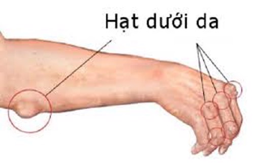 Các triệu chứng của bệnh viêm khớp dạng thấp - Chuyên gia Vũ Thị Khánh Vân tư vấn