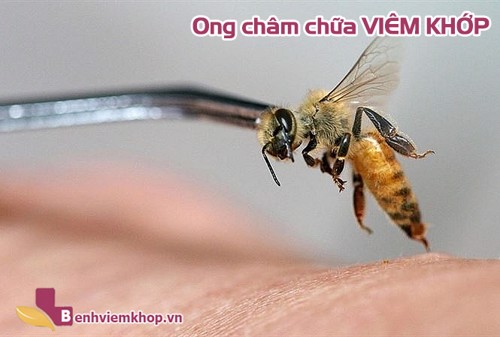 Ong châm CHỮA VIÊM KHỚP có mang lại hiệu quả như lời đồn?