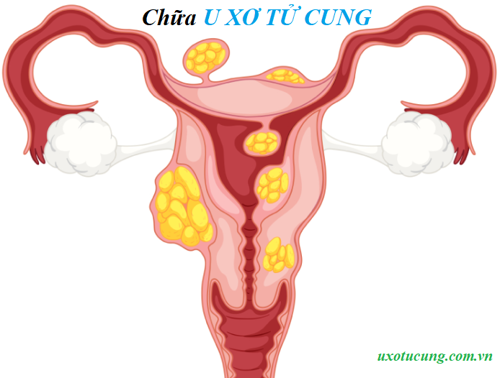 Chữa u xơ tử cung bằng bài thuốc Đông y - Nam y kết hợp