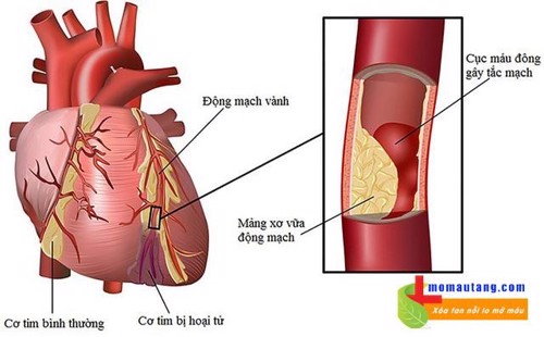 Biến chứng rối loạn lipid máu là gì? Tìm hiểu ngay!