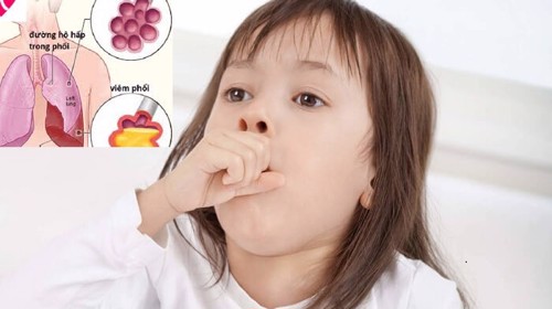 Viêm phổi ở trẻ em là gì? Làm sao để phòng và điều trị bệnh hiệu quả?