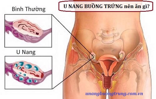 Bị u nang buồng trứng nên ăn gì để tốt cho sức khỏe