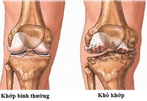 Bệnh khô khớp để lâu thì dẫn đến viêm khớp không? TS Mai Thị Minh Tâm tư vấn