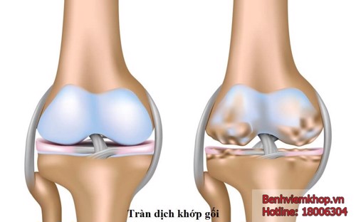 Bị đau khớp gối phải có nên đi hút dịch khớp nhiều lần không? TS Mai Thị Minh Tâm tư vấn