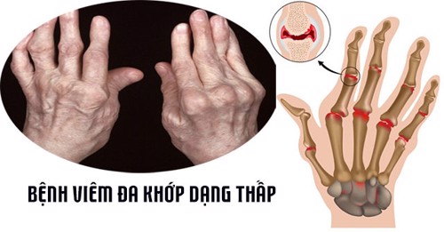 Điều trị viêm khớp dạng thấp bằng đông y hay tây y thì tốt? TS Mai Thị Minh Tâm tư vấn