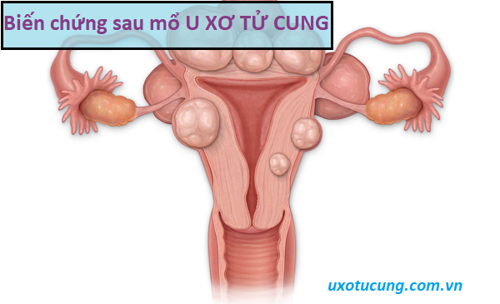 Những biến chứng sau mổ u xơ tử cung – Những điều bạn chưa biết!