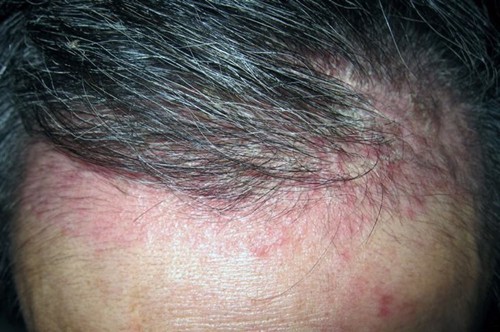 Bệnh vảy nến da đầu có lây không? Chuyên gia Nguyễn Thành tư vấn