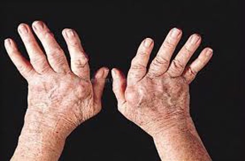 Viêm khớp dạng thấp là gì? TS Mai Thị Minh Tâm tư vấn