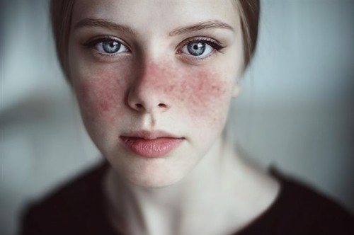 Bị tác dụng phụ khi sử dụng Medrol điều trị lupus ban đỏ có nên ngừng sử dụng không?