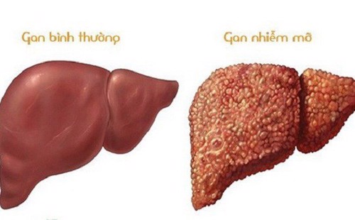 Bị gan nhiễm mỡ độ 1 bao lâu thì chuyển sang độ 2, điều trị thế nào? PGS.TS Nguyễn Văn Quýnh tư vấn