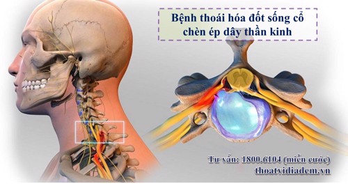 4 bệnh “họ hàng” với thoái hóa đốt sống cổ - Xem ngay để biết