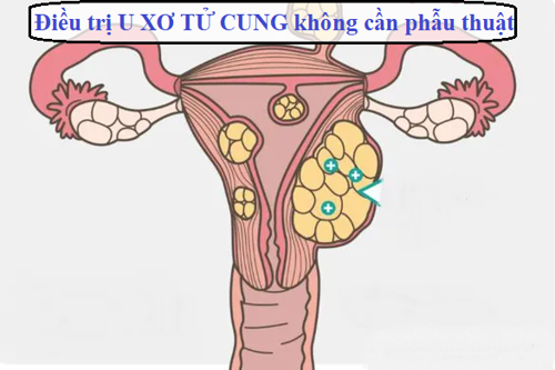 "Tuyệt chiêu" làm tiêu u xơ tử cung nhanh chóng mà không cần phẫu thuật khiến bác sĩ cũng phải ngạc nhiên!