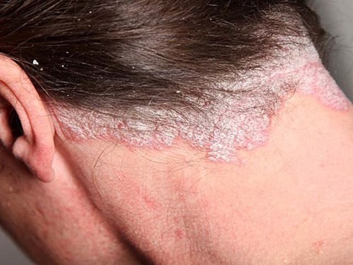 Bị vảy nến da đầu nhẹ điều trị như thế nào cho nhanh khỏi? Chuyên gia Ngô Xuân Nguyệt tư vấn