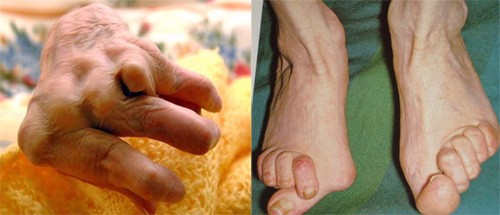 Viêm khớp dạng thấp gây nên những biến chứng nguy hiểm gì? Chuyên gia Nguyễn Thị Lực giải đáp