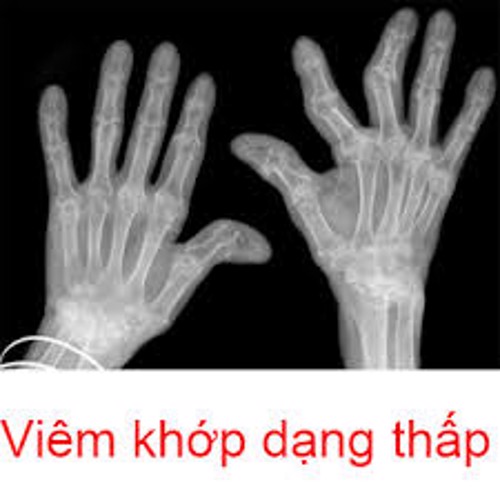 Viêm khớp dạng thấp là gì? Chuyên gia Nguyễn Thị Lực giải đáp