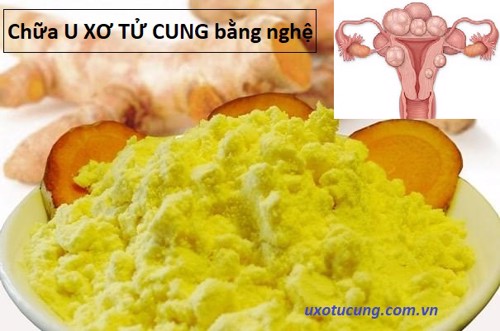 Chữa u xơ tử cung bằng nghệ vàng – Liệu bạn có hay?