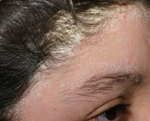 Cách điều trị bệnh vảy nến da đầu nào tốt? Chuyên gia Ngô Xuân Nguyệt tư vấn