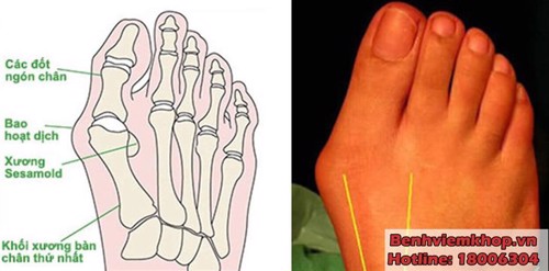 Bệnh VIÊM KHỚP NGÓN CHÂN và những lưu ý cần thiết