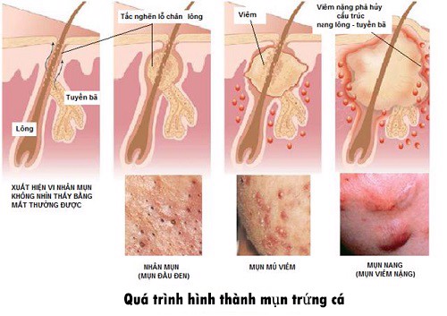 4 cách trị mụn trứng cá tại nhà hiệu quả. CLICK ngay!