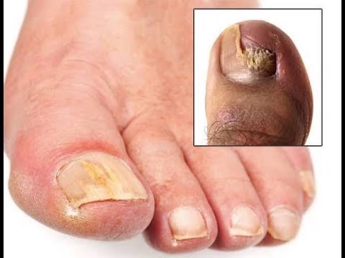 Da chân khô sần sùi, móng chân bị ăn sâu là dấu hiệu của bệnh gì?