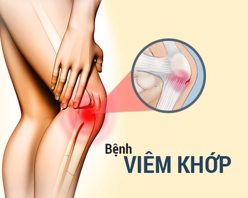 Bị viêm khớp gối liệu có dẫn đến tàn phế không? Chuyên gia Mai Thị Minh Tâm giải đáp