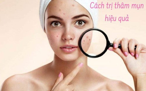 Chuyên gia Nguyễn Thị Hiền hướng dẫn cách trị vết thâm mụn tại nhà hiệu quả