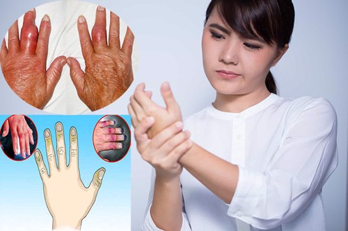 Chữa viêm đa khớp bằng thuốc nam có thực sự hiệu quả không? Chuyên gia Mai Thị Minh Tâm tư vấn