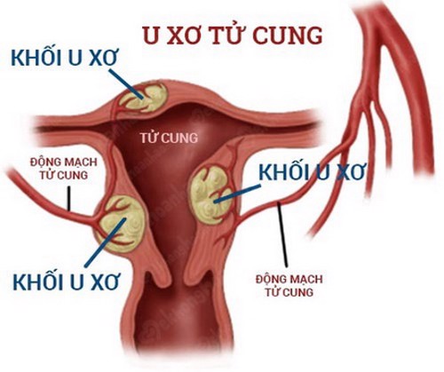 U xơ tử cung có nguy hiểm không - Dấu hiệu u xơ tử cung là gì?