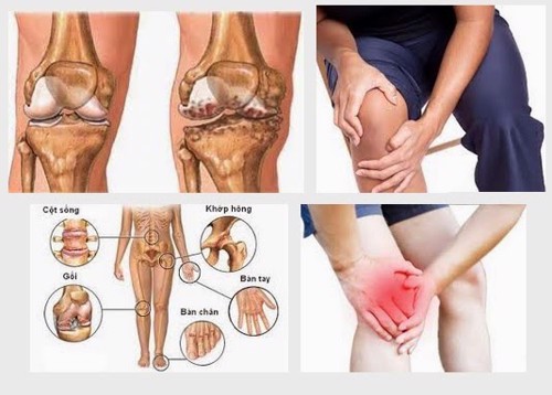 Có cách nào để phòng ngừa các đợt viêm khớp cấp không? Chuyên gia Mai Thị Minh Tâm giải đáp