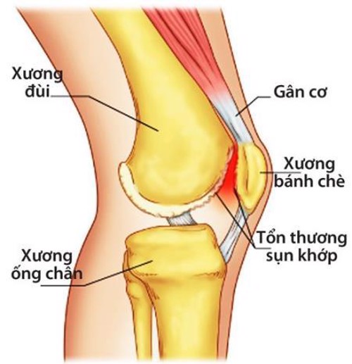 Viêm khớp đầu gối là gì? Nguyên nhân và biện pháp khắc phục hiệu quả