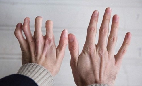 Chuyên gia Mai Thị Minh Tâm chia sẻ bài thuốc chữa viêm khớp dạng thấp hiệu quả nhất