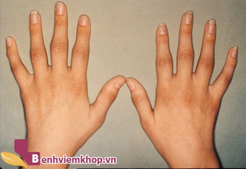 Bệnh viêm đa khớp dạng thấp và các biến chứng nguy hiểm không thể xem thường