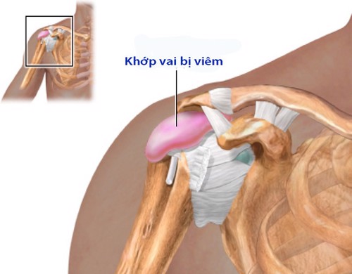 Bệnh viêm quanh khớp vai là gì? TS Nguyễn Thị Vân Anh tư vấn