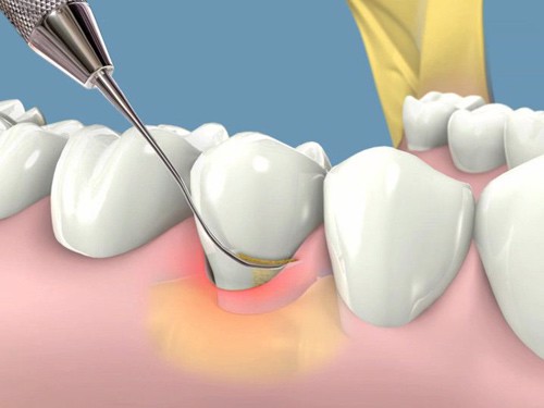 Bệnh viêm lợi và cách điều trị như thế nào? Chuyên gia Nguyễn Hồng Hải tư vấn