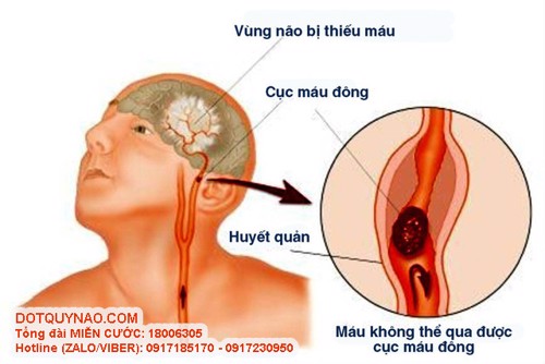 Tai biến nhẹ: Triệu chứng và những điều có thể bạn chưa biết