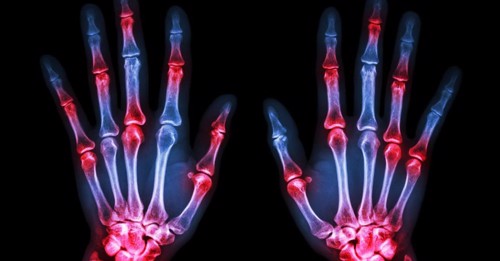 Người bị viêm khớp dạng thấp nên có chế độ ăn uống, sinh hoạt và tập luyện như thế nào?