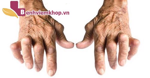 Sử dụng thuốc điều trị VIÊM ĐA KHỚP DẠNG THẤP cần có những lưu ý gì?