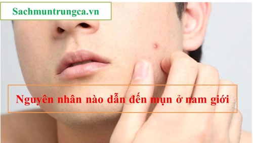 TOP các cách trị mụn tại nhà cho nam giới hiệu quả