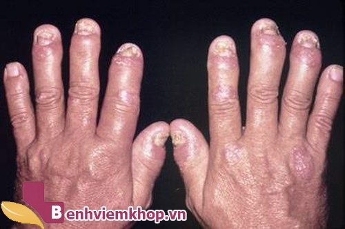 8 biện pháp khắc phục các triệu chứng bệnh viêm khớp dạng thấp hiệu quả
