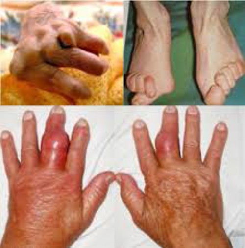 Khi có triệu chứng viêm đa khớp dạng thấp, nếu không điều trị sẽ gây ra hậu quả như thế nào?