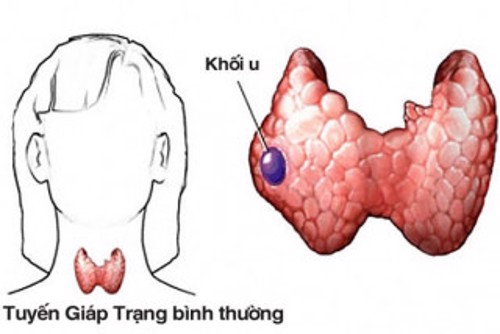 Bệnh u nang tuyến giáp có nguy hiểm không? – Xem ngay để biết!