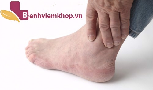 Ghi nhớ 5 điều này nếu không muốn bị VIÊM KHỚP MẮT CÁ CHÂN “hành hạ”