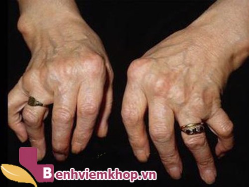 Sử dụng bùn khoáng chữa viêm khớp dạng thấp như thế nào?