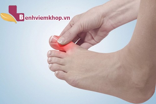 Biến chứng nguy hiểm của viêm khớp ngón chân cái và biện pháp khắc phục