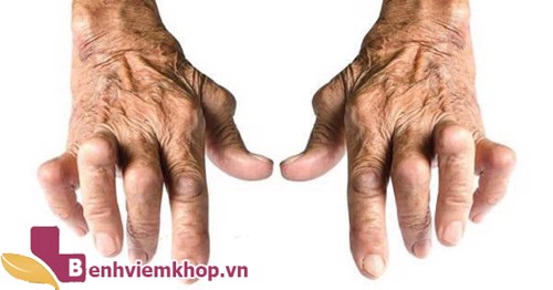 Chữa viêm khớp dạng thấp bằng thuốc nam thực hiện như thế nào?