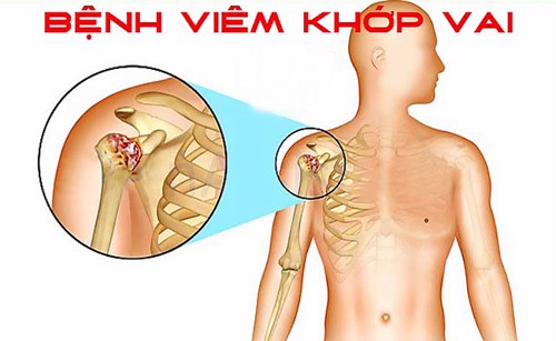 Bị viêm khớp vai nên dùng thuốc như thế nào cho hiệu quả? PGS. TS Dương Trọng Hiếu tư vấn